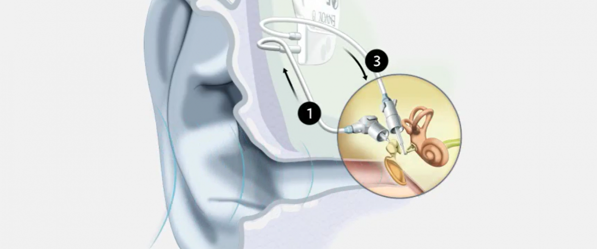 Envoy Medical Implantable Cochlear Systems