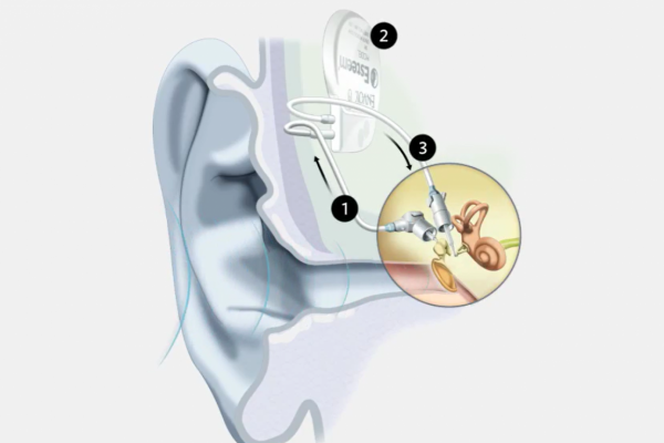Envoy Medical Implantable Cochlear Systems